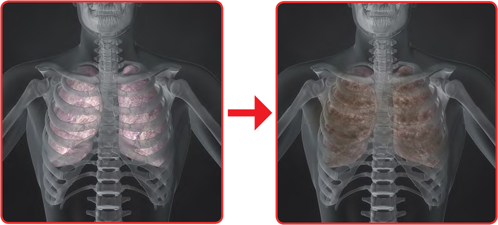 Image of clean, healthy lungs, and image of unhealthy lungs